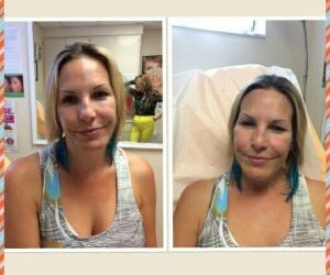 Check out some of our Before & Afters! Just some amazing procedures done in our office by Dr. Daisy Merey! Contact us today to schedule your appointment (561) 659-6756